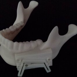 Gedrucktes Kiefermodell mit Bohr- bzw. Frässchablone