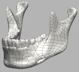 Computermodell eines Unterkiefers mit Tumor
